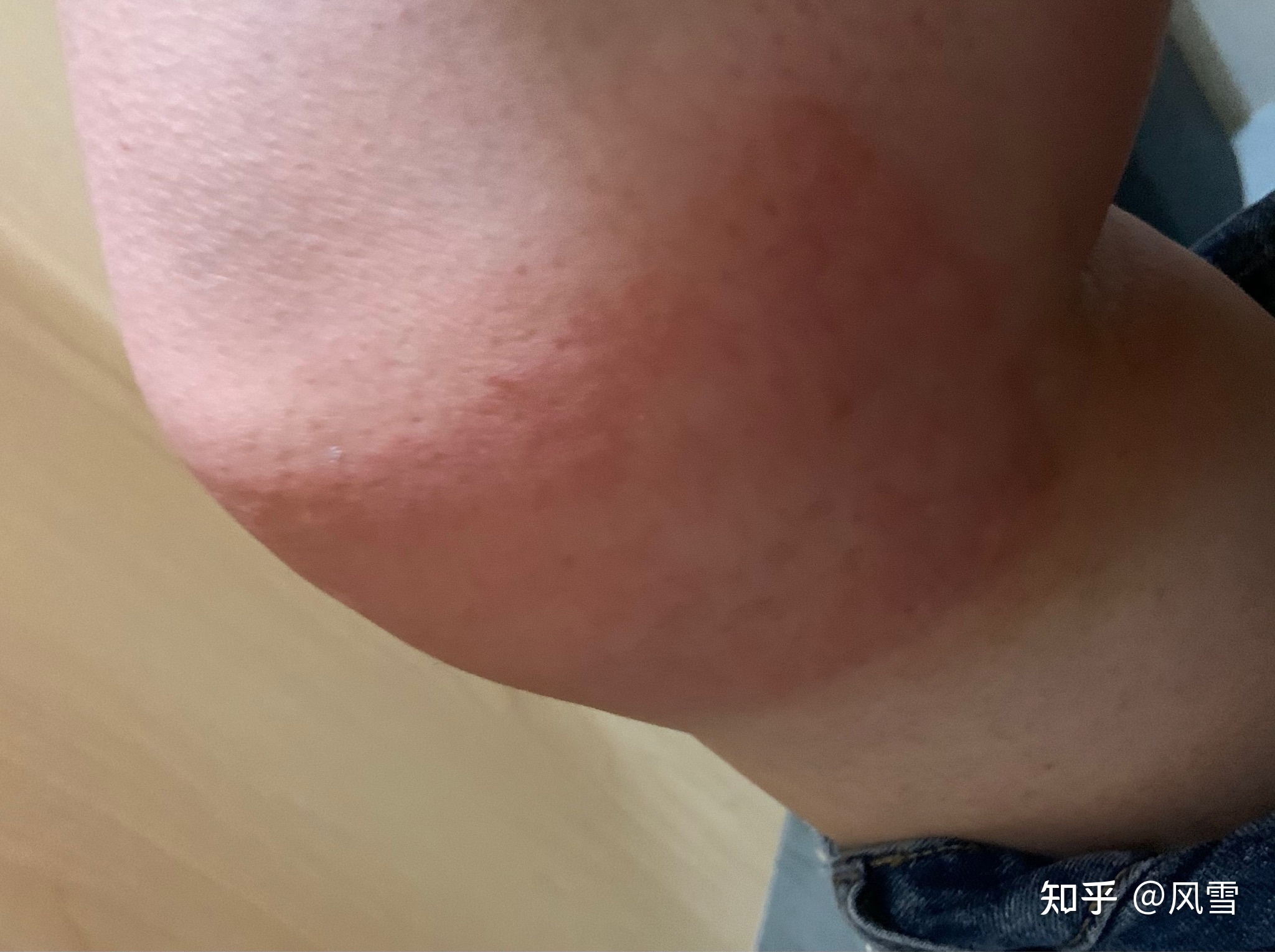 1、貼膏藥過敏癢紅腫怎么辦？